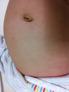 乳児湿疹 胸からお腹にかけてのぶつぶつぽんの日記 妊娠 出産 育児 働くママ